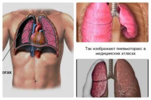 Боли после пневмоторакса