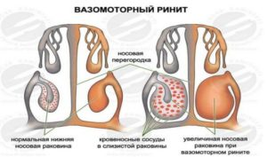 Кровяные выделения при насморке. Вазомоторный ринит