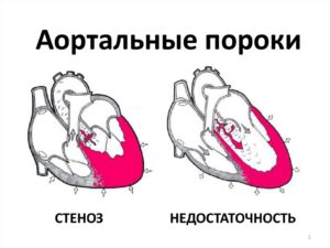 Комбинированный порок аортального клапана