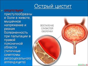 Как вылечить хронический цистит