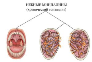 Хронический тонзиллит и ревматоидный фактор
