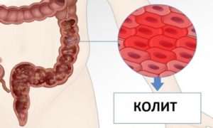 Колит+геморрой