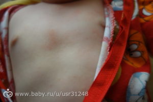 Красные пятна на груди у ребенка