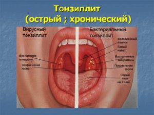 Хронический тонзиллит и постоянные простуды