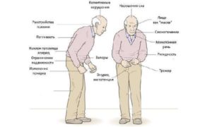 Перепады давления при болезни Паркинсона