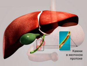 Камень в желчном протоке