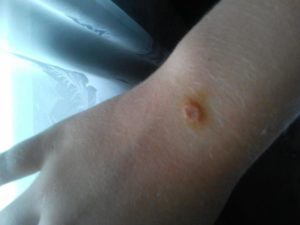 Болячка на руке похожая на укус комара