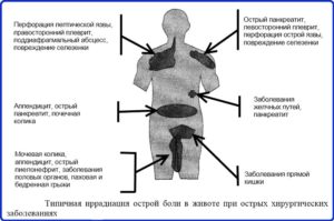 Боль в желудке с иррадиацией