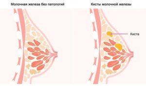 Болит грудь перед месячными