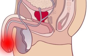 Болит пенис при мочеиспускании