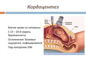 КорДоцентез