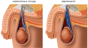 Киста и варикоцеле