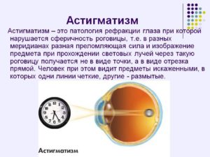 Какие физические ограничения при осложненном астигматизме