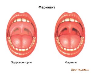 Хронический фарингит, пятна на твердом нёбе