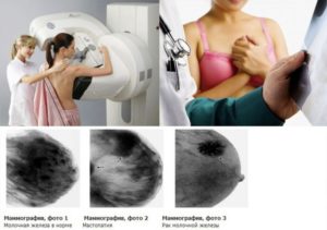 Маммография на ранних сроках беременности