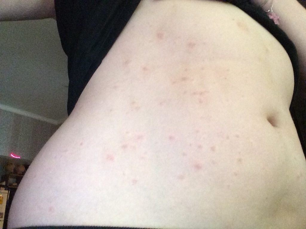 Красные прыщики по бокам живота