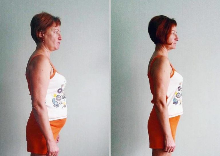 После 40 почему полнеют. Похудевшая женщина. Похудение до и после. Похудение после гормонов. Гипотиреоз фигура женщины.