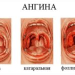 Инвалидность при Адамантиноме большеберцовой кости