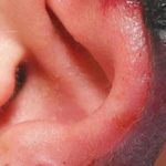 Кровавый пузырь под кожей на лице