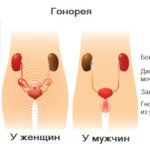 Песок в почках боли в пояснице