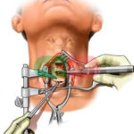 Кистозно-солидное образование в щитовидной железе