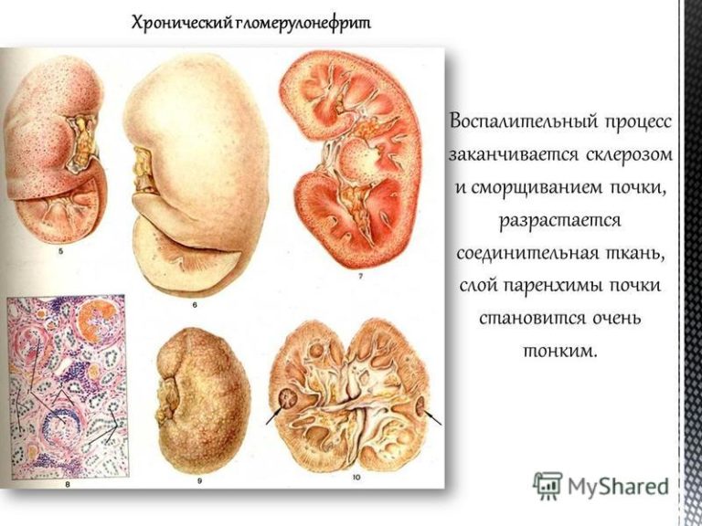 Пиелонефрит и гломерулонефрит у детей презентация