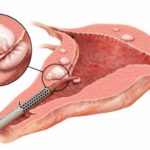 Короткий процесс полового акта после обрезания