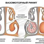 Как долго принимать после инфаркта клопидогрил?